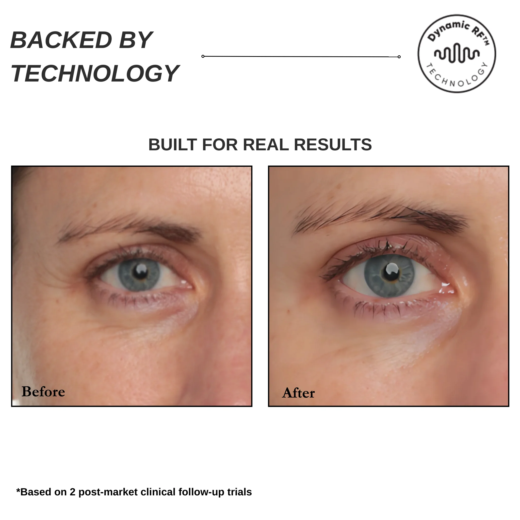 Sensilift Mini Skin Tightening - Image 6