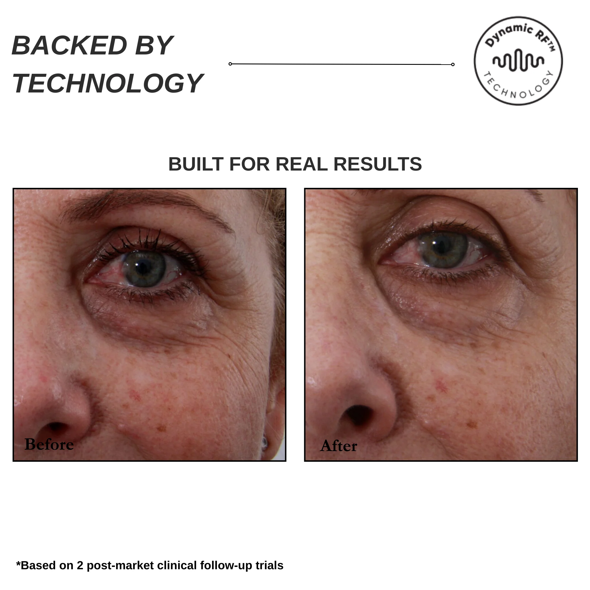 Sensilift Smart RF Skin-Firming - Image 7