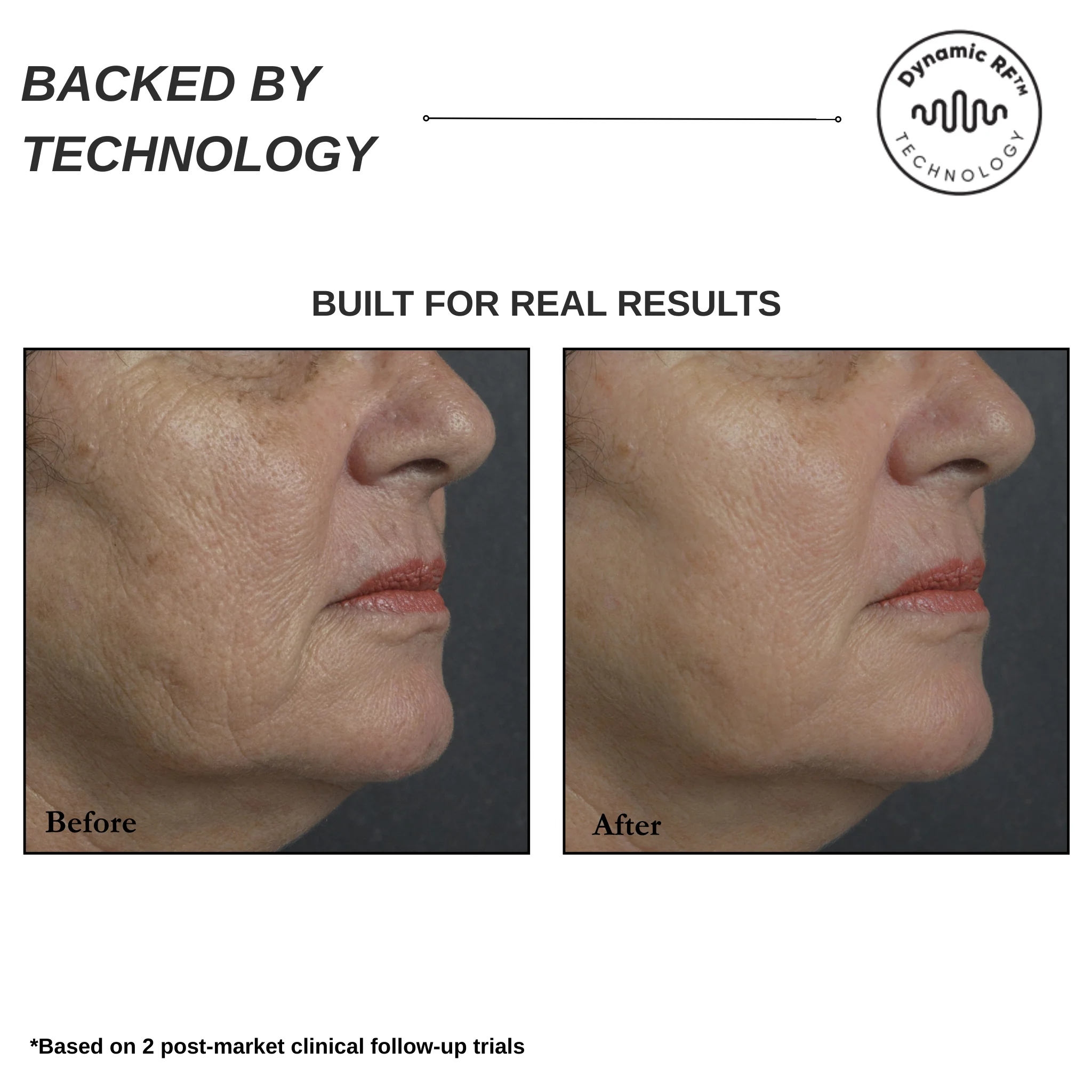 Sensilift Smart RF Skin-Firming - Image 8