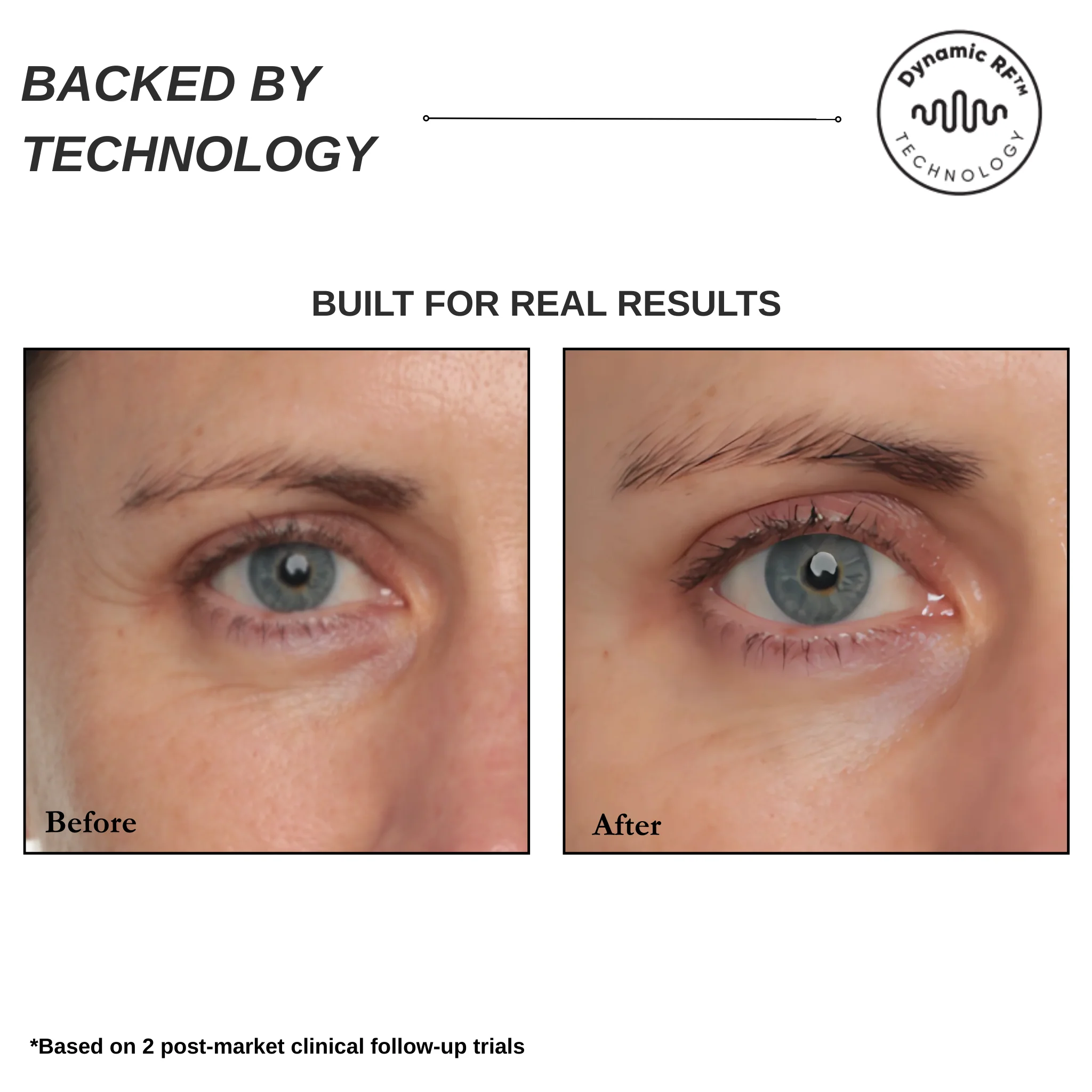 Sensilift Smart RF Skin-Firming - Image 6