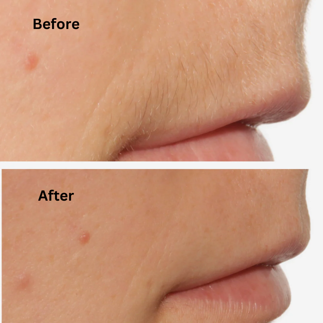 Sensilight Mini Smart Hair-Removal - Image 11