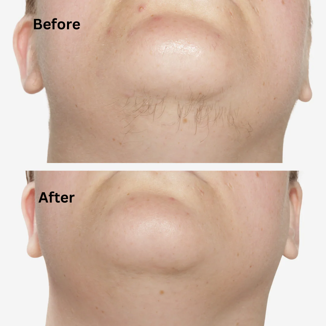 Sensilight Mini Smart Hair-Removal - Image 7