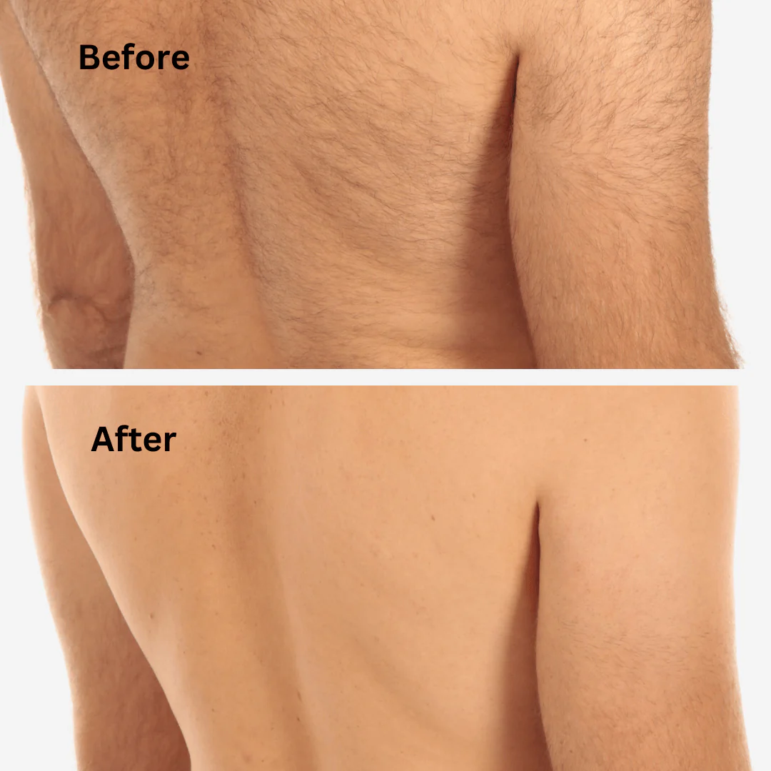 Sensilight Pro At-Home Hair Removal - Image 7