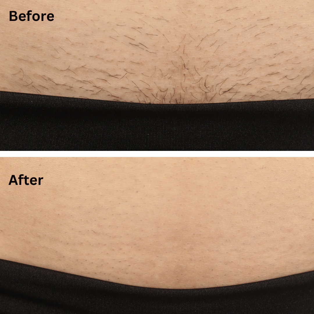 Sensilight Pro At-Home Hair Removal - Image 8