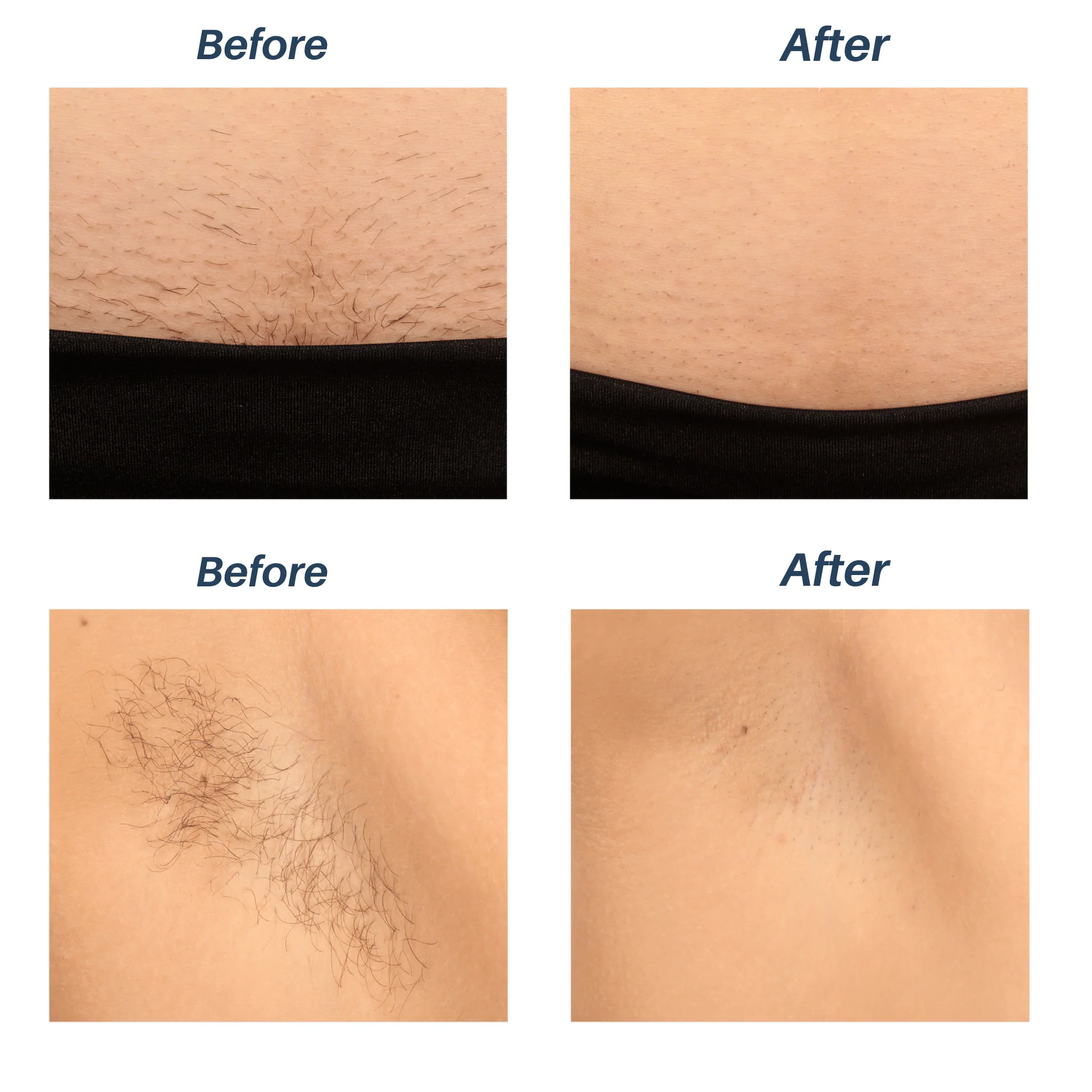 Sensilight Pro Lasting Hair Removal - Image 6