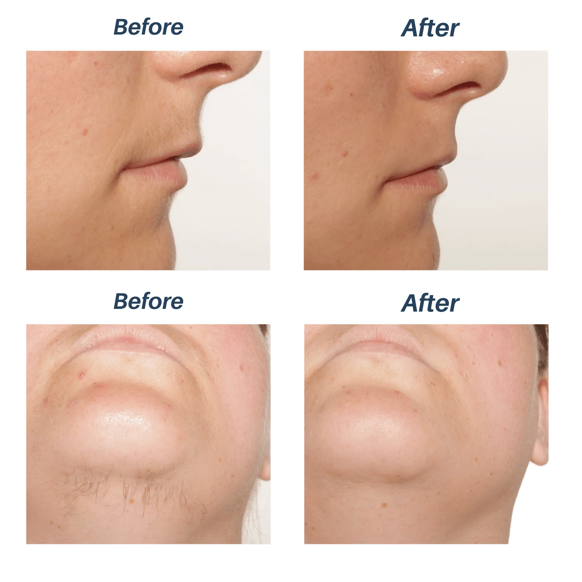 Sensilight Pro Lasting Hair Removal - Image 7